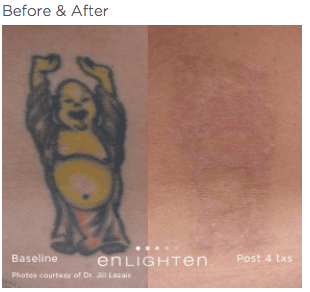 enlighten Tattoo Removal 3