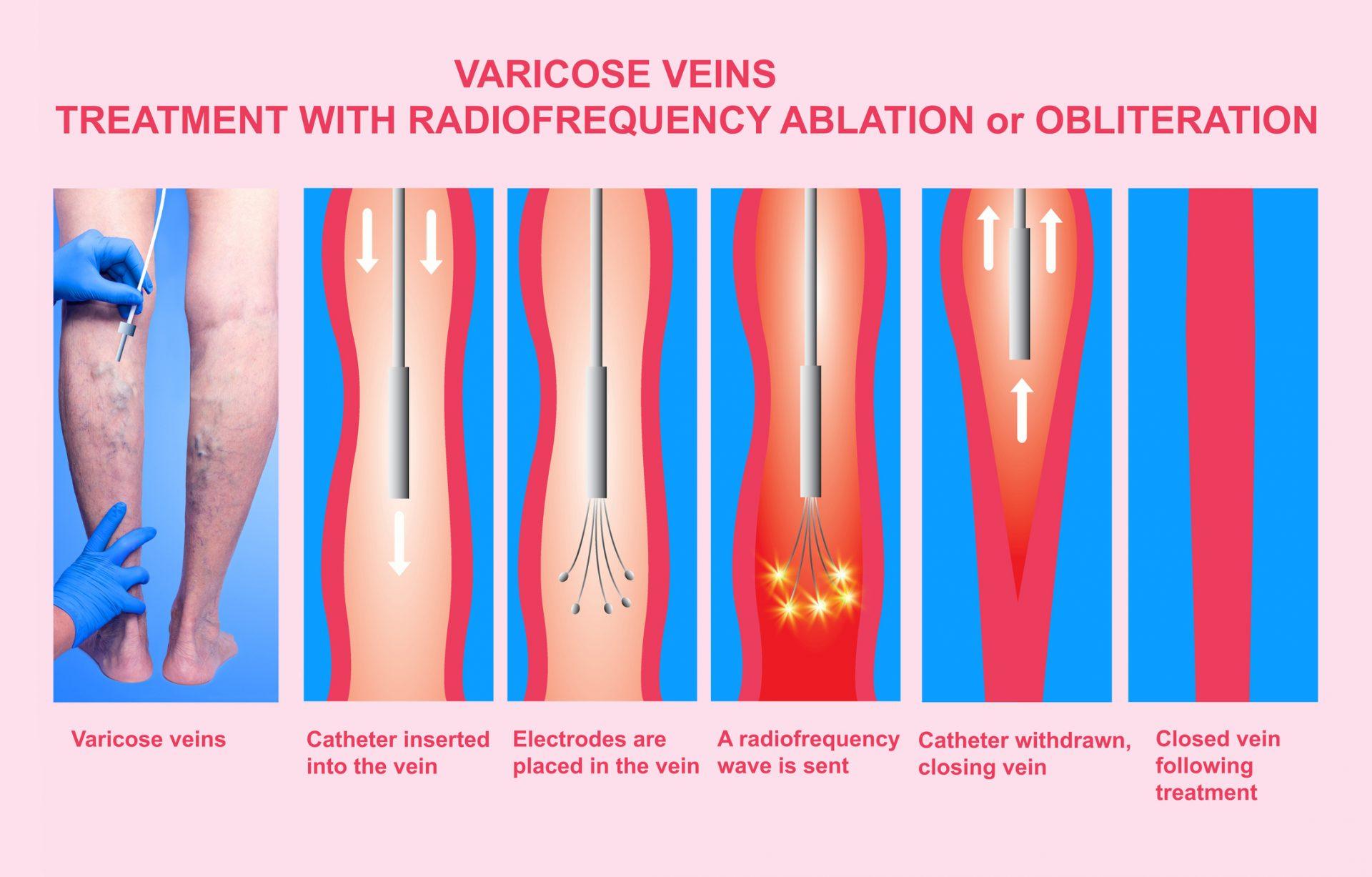 Spider Vein Treatment, VeinErase