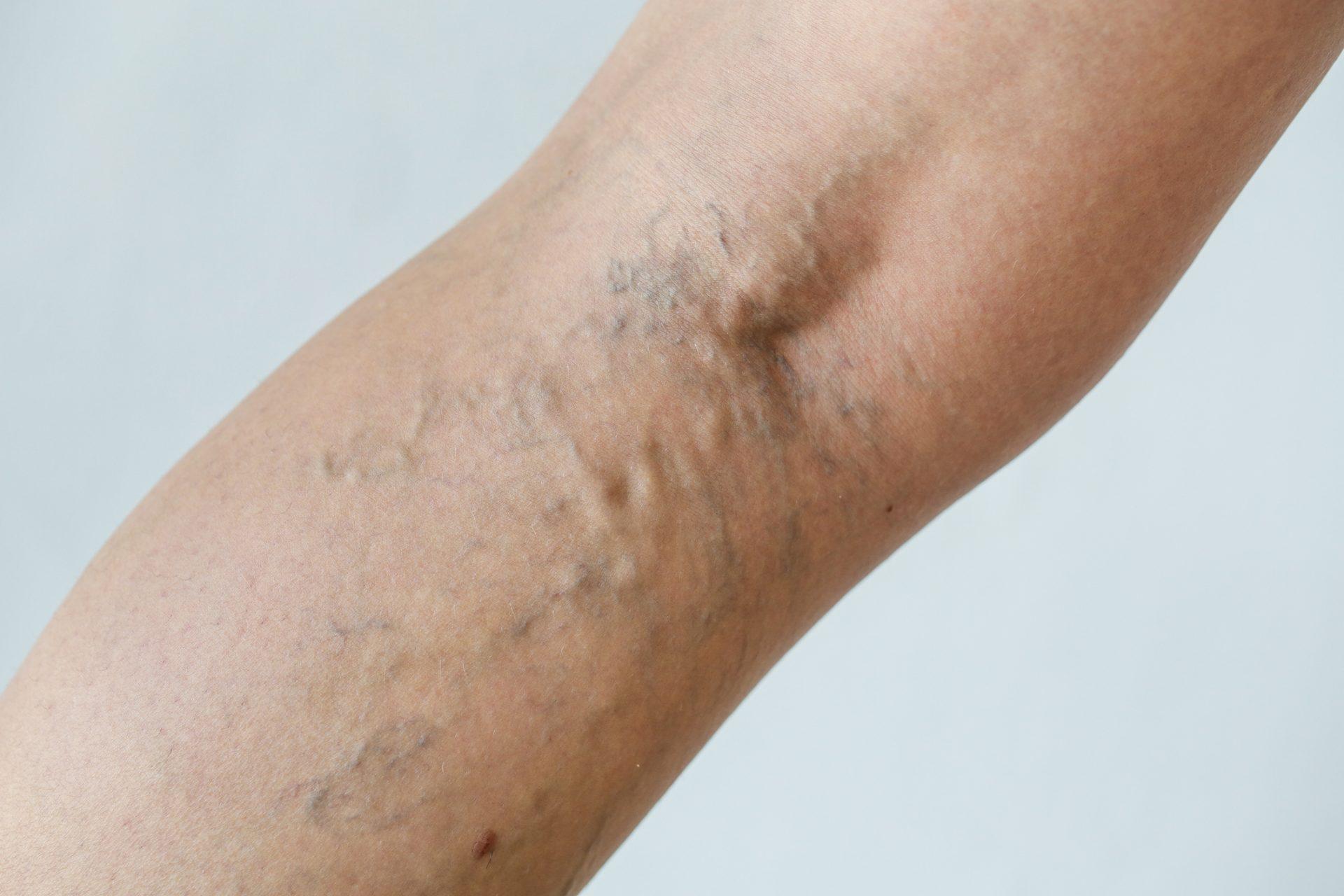 Spider Vein Treatment, VeinErase